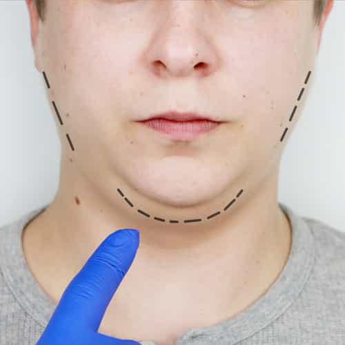 Facelift Surgery in Vietnam vs Australia – Which Is Safer and More Affordable?